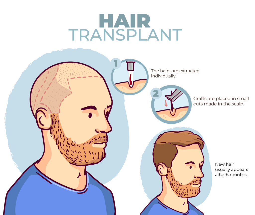 PRP Hair Loss Treatment in Karachi